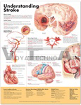 Understanding Stroke Anatomical Chart, 2nd Edition